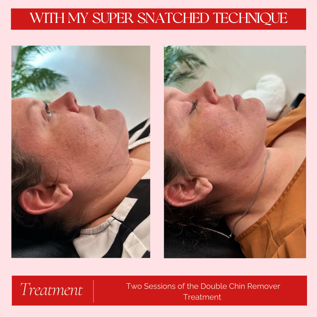 Double Chin Treatment - 3 Sessions