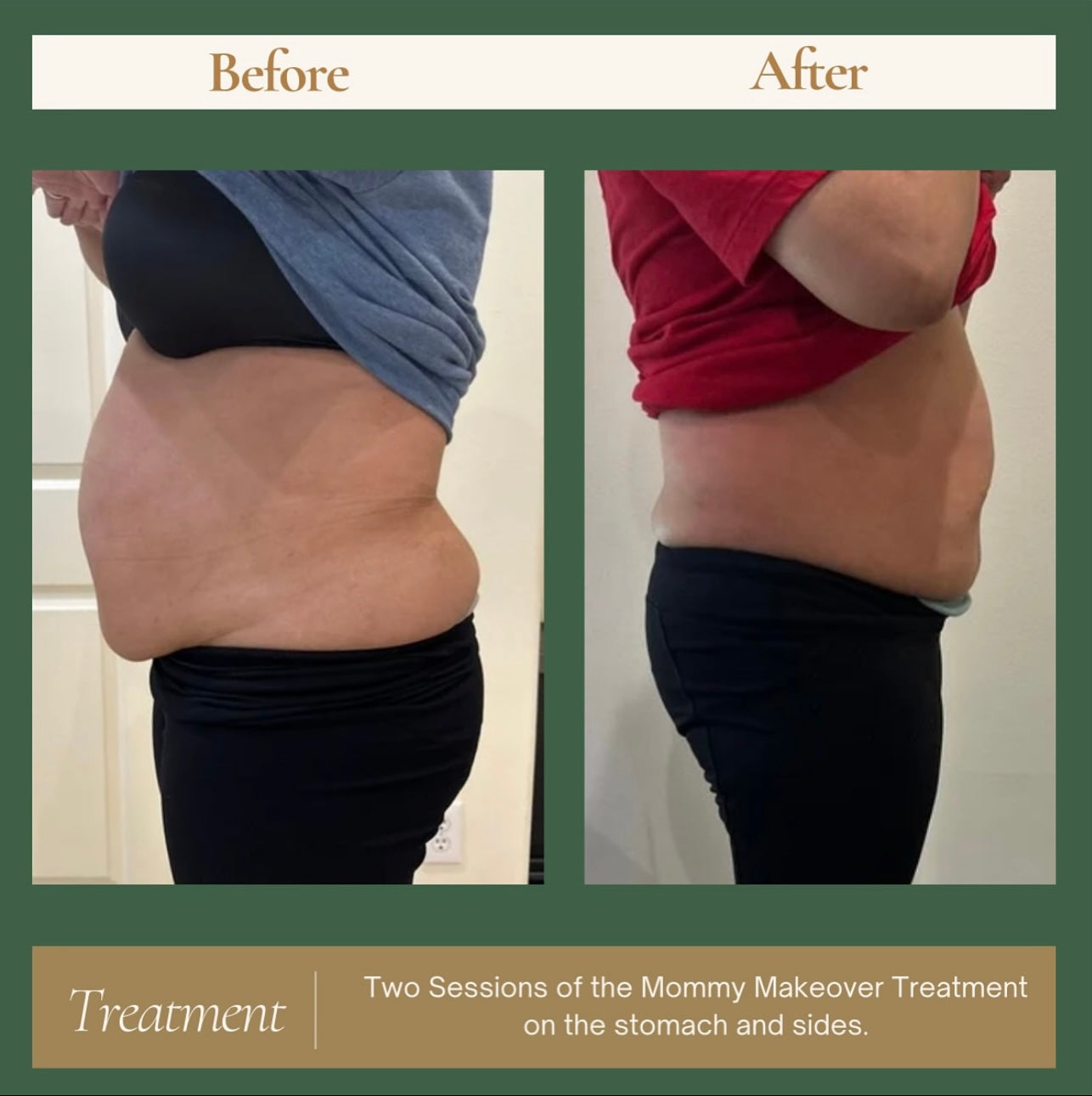 Mommy Makeover - 3 Sessions