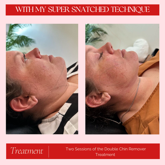 Double Chin Treatment - 3 Sessions